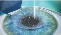 飞秒激光LASIK.jpg